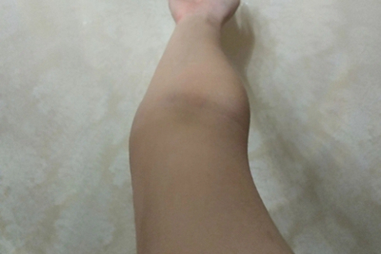 肘外翻胳膊伸不直变形图 肘外翻胳膊伸不直变形图