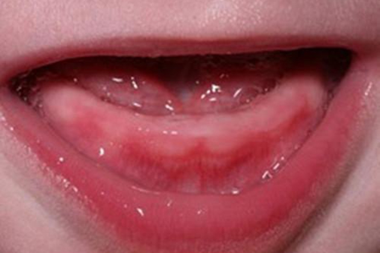 宝宝长牙牙龈红肿充血图 宝宝长牙牙龈红肿充血图