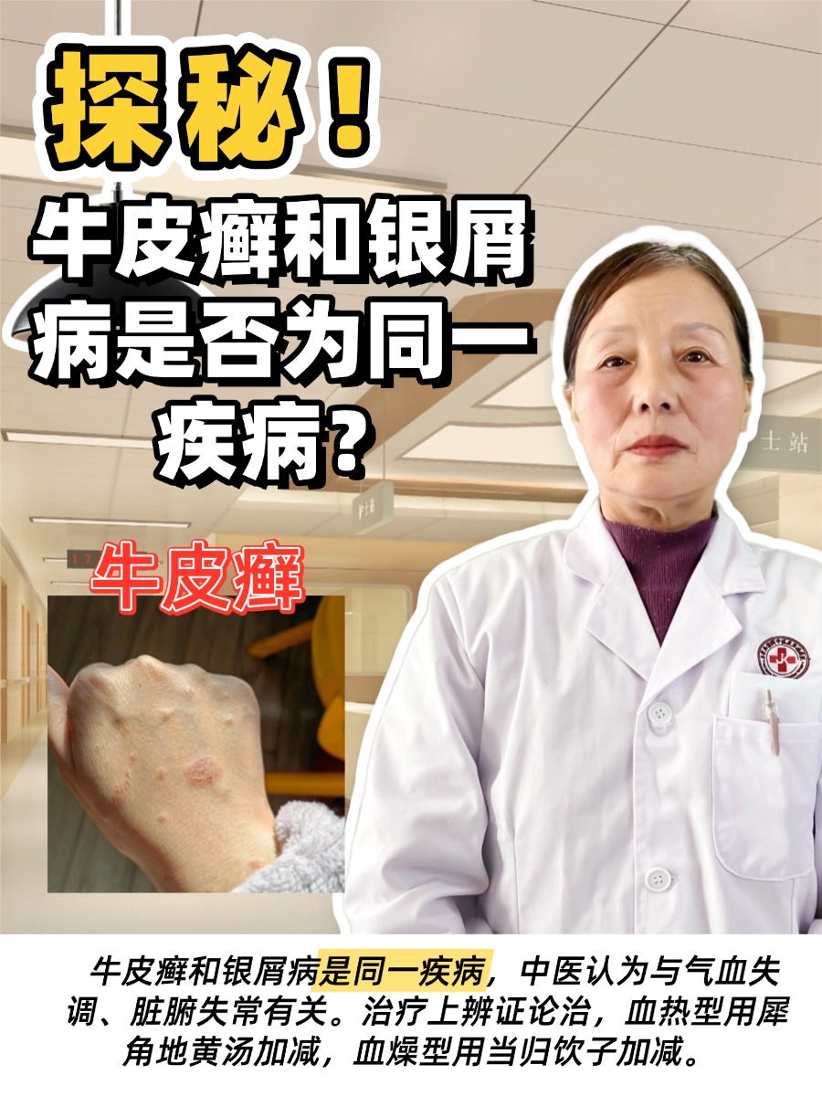 探秘!牛皮癣和银屑病是否为同一疾病?