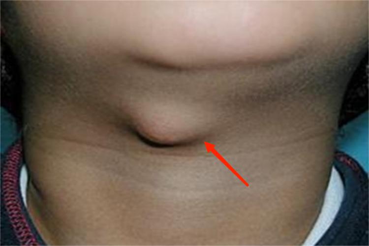 慢性颌下腺炎下巴肿块图 慢性颌下腺炎下巴肿块图