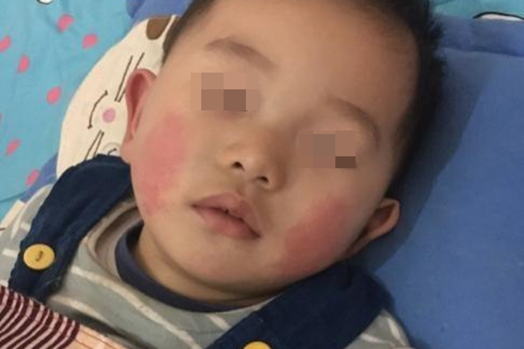 宝宝积食面颊发红图