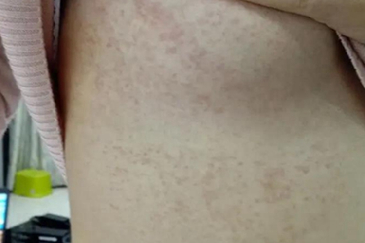 融合性网状乳头瘤病胸部丘疹图