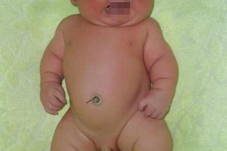 先天性软骨发育不良婴儿四肢短小图