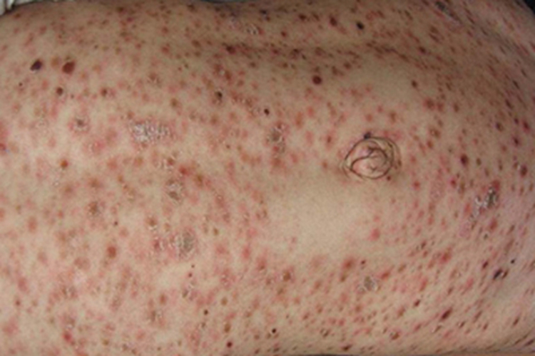 急性痘疮样苔藓样糠疹腹部结痂图