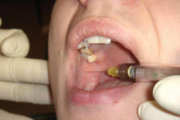 下牙槽神经局麻图