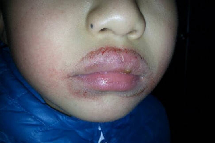 小孩咬嘴唇出现色素沉着图