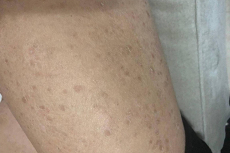 慢性苔藓样糠疹腿部脱屑图 慢性苔藓样糠疹腿部脱屑图