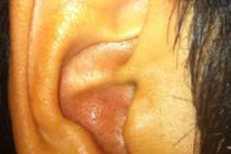 外耳道疖肿图