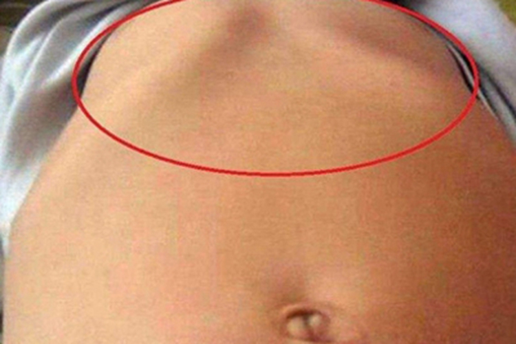 维生素D依赖性佝偻病症状图 维生素D依赖性佝偻病症状图