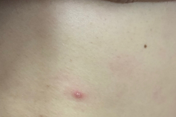 毛囊炎背部脓包图