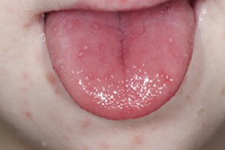 手足口病口腔丘疹图