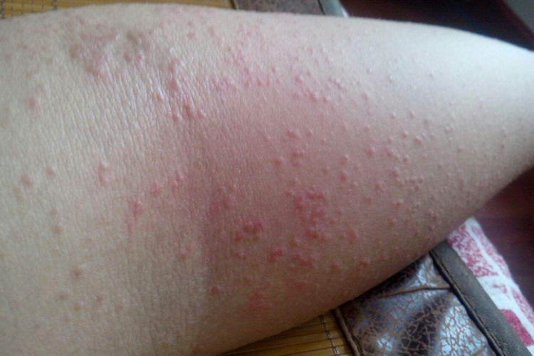 手肘内窝急性湿疹图 手肘内窝急性湿疹图