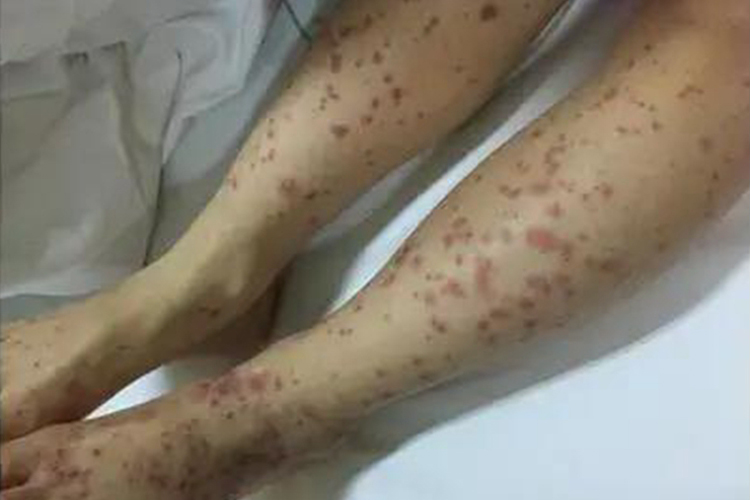 毛细血管炎早期症状图