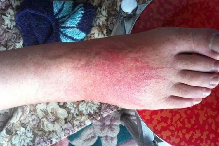 痒疹图 痒疹图