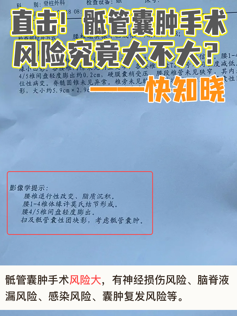 直击！骶管囊肿手术风险究竟大不大？快知晓