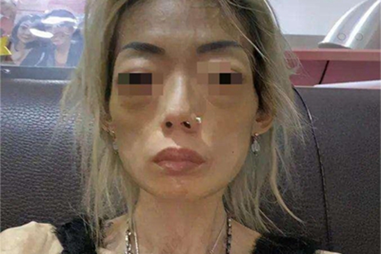 进行性脂肪营养不良变形图