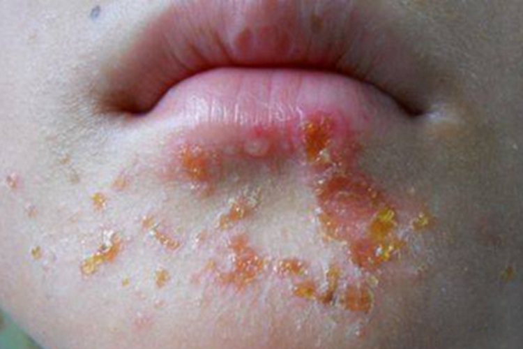 类脂质蛋白沉积症下巴水疱图 类脂质蛋白沉积症下巴水疱图