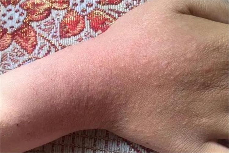 过敏性皮炎手背症状图