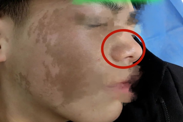 咖啡斑鼻部斑图