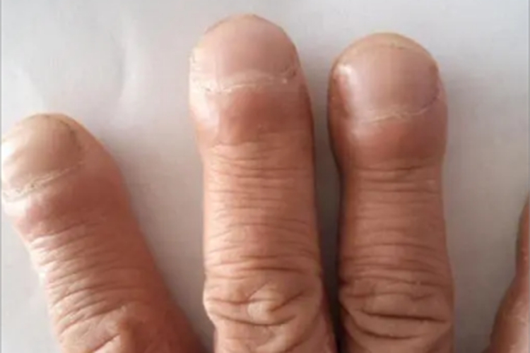 杵状指手指尖膨大变圆图