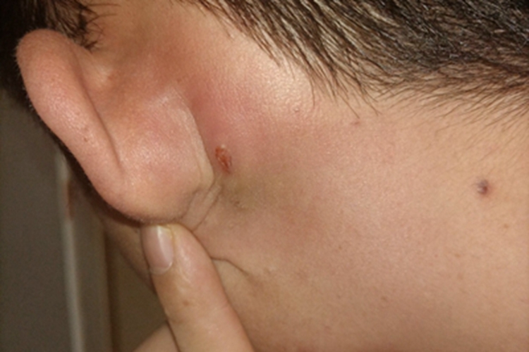 皮脂腺囊肿耳后糜烂图