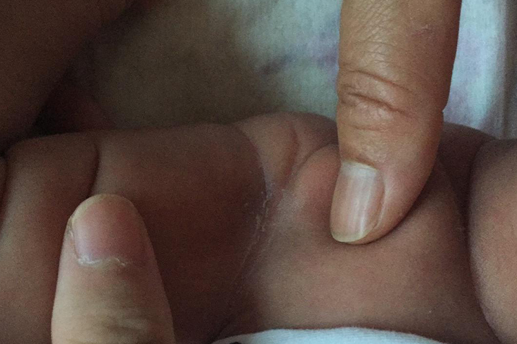 男宝宝皮肤擦伤大腿内侧破皮图