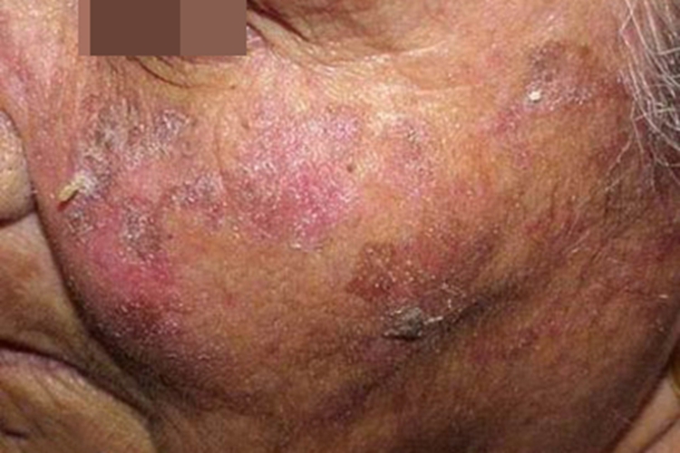日光性角化病面部红斑图
