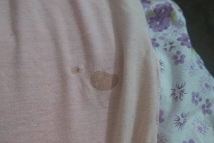 乳头溢液血迹图