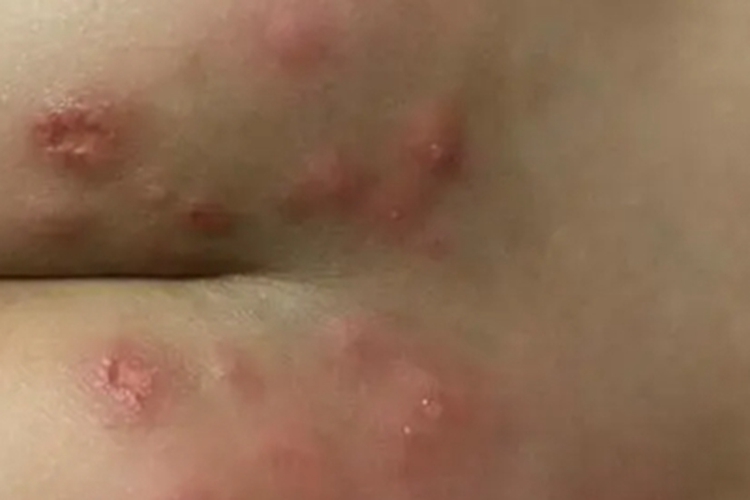 热带痤疮臀部疙瘩图