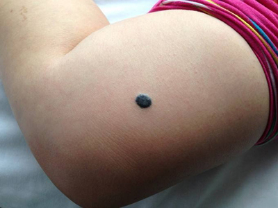 普通蓝痣大腿上长个蓝色的斑块图