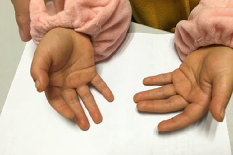 胡萝卜素血症手部症状图