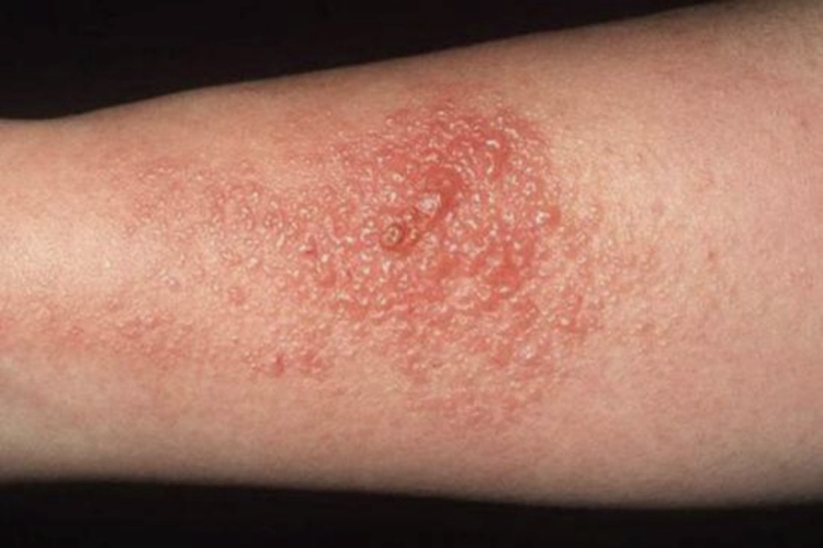 壁虎尿引起皮肤起疱图