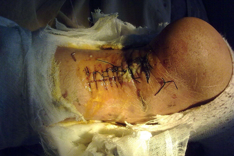 跟腱手术伤口感染不愈合图