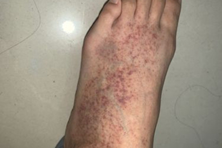 高球蛋白血症性紫癜脚部症状图