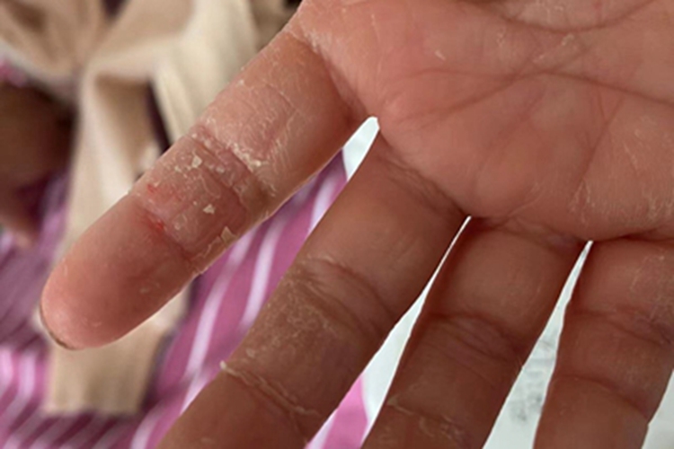 皮肤皲裂手指脱皮图 皮肤皲裂手指脱皮图