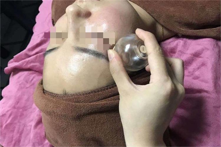 脸上拔罐图 脸上拔罐图