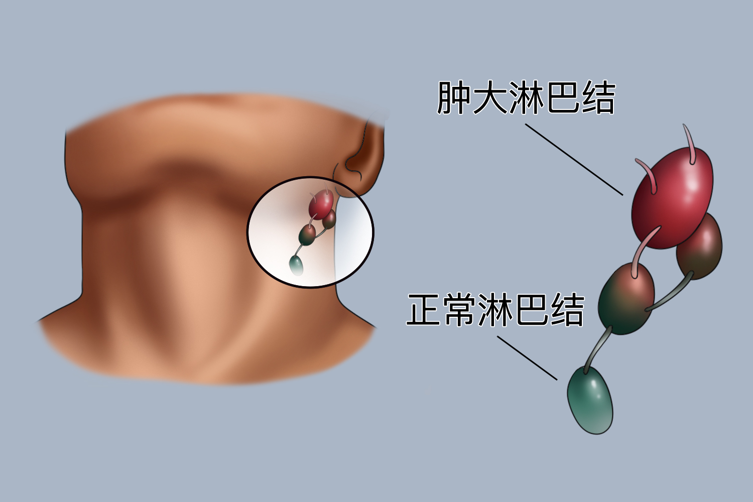 颈部淋巴结正常及异常形态图