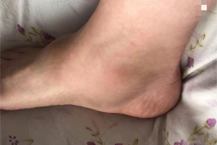剥脱性骨软骨炎脚踝有肿块图