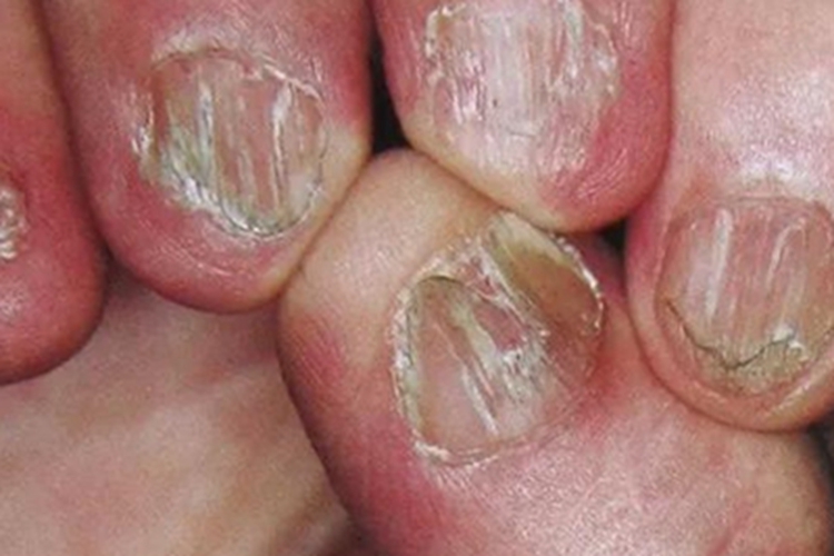 甲胬肉手指甲粗糙变形图