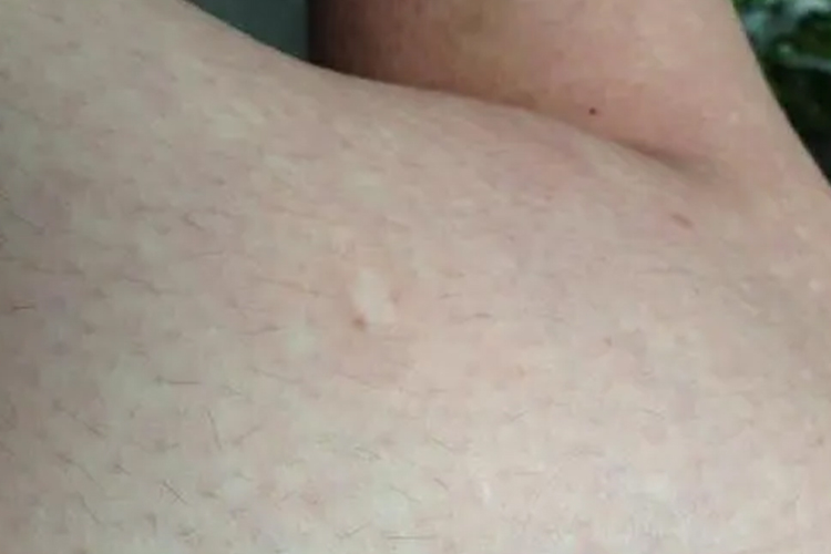 贫血痣图 贫血痣图