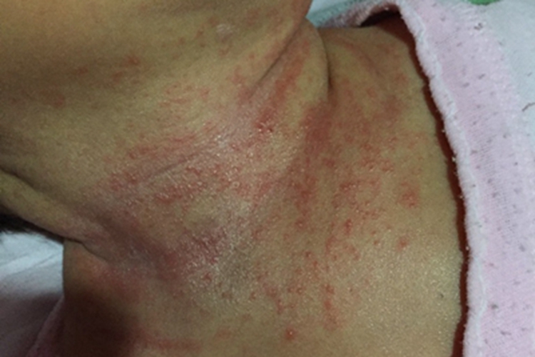 柯萨奇湿疹颈部小水疱图 柯萨奇湿疹颈部小水疱图