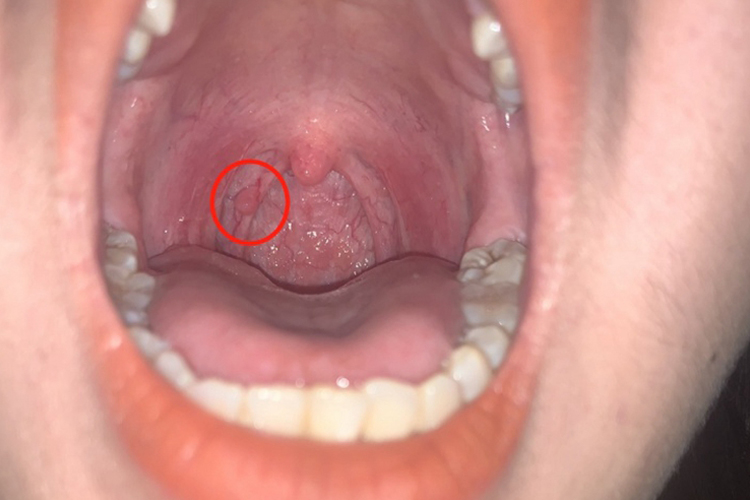 扁桃体乳头状瘤图