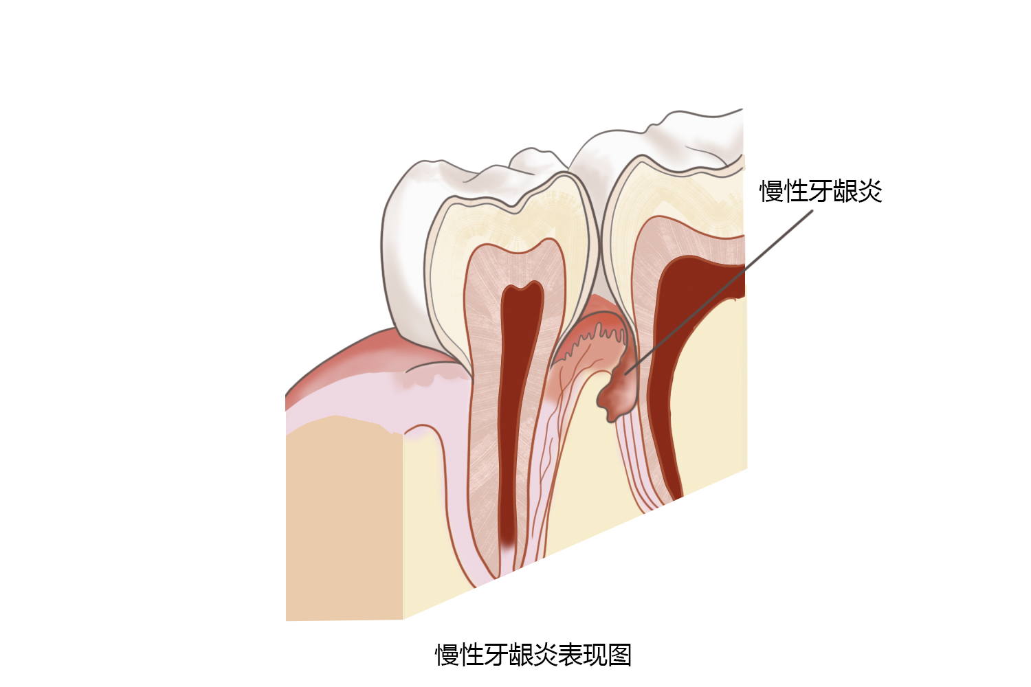 急性龈乳头炎