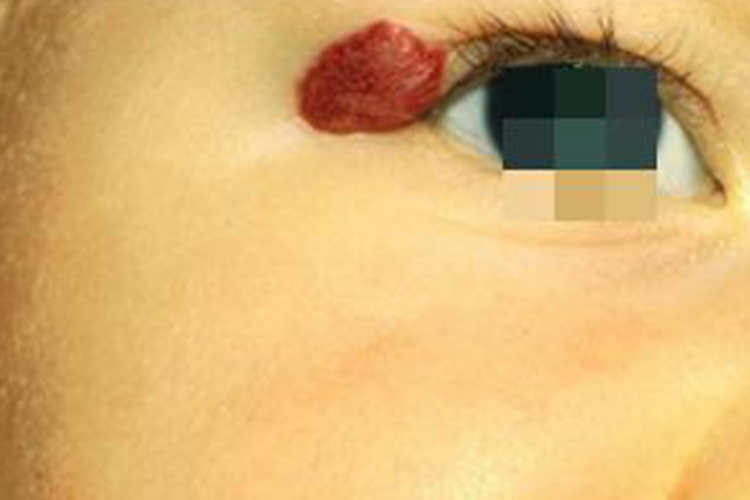 血管瘤眼角小红疙瘩图 血管瘤眼角小红疙瘩图