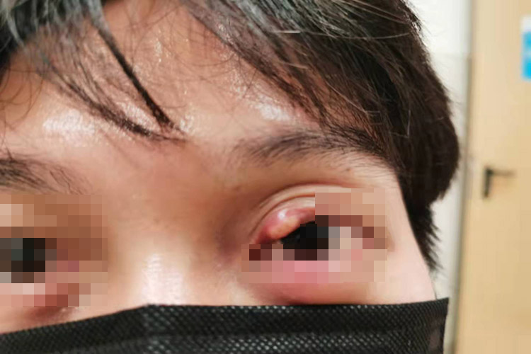 外睑腺炎症状图