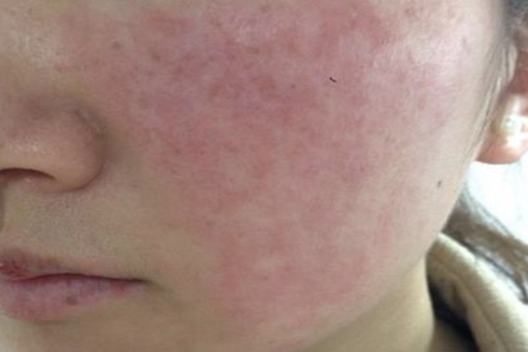 冻干粉过敏症状图