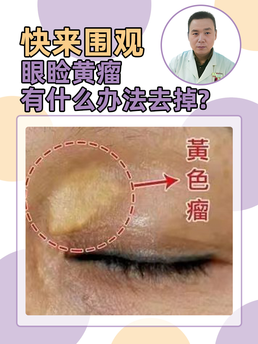 快来围观——眼睑黄瘤有什么办法去掉?