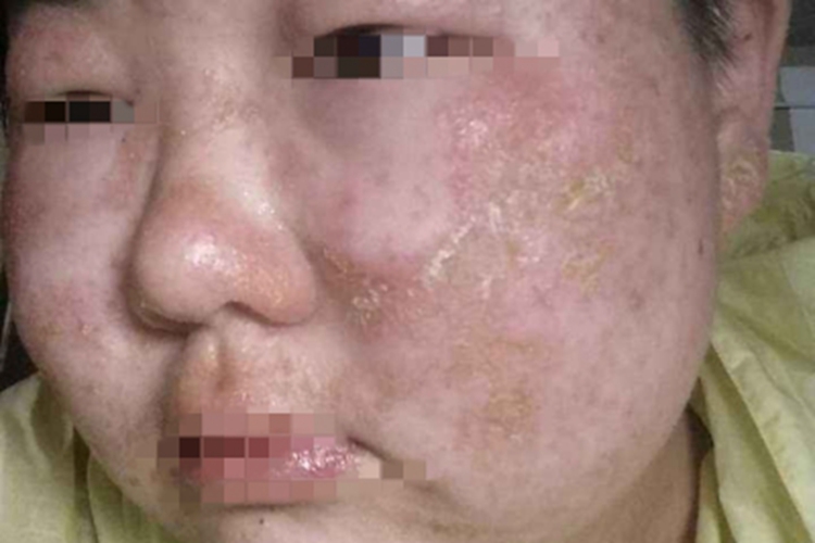 植物-日光性皮炎面部结痂图