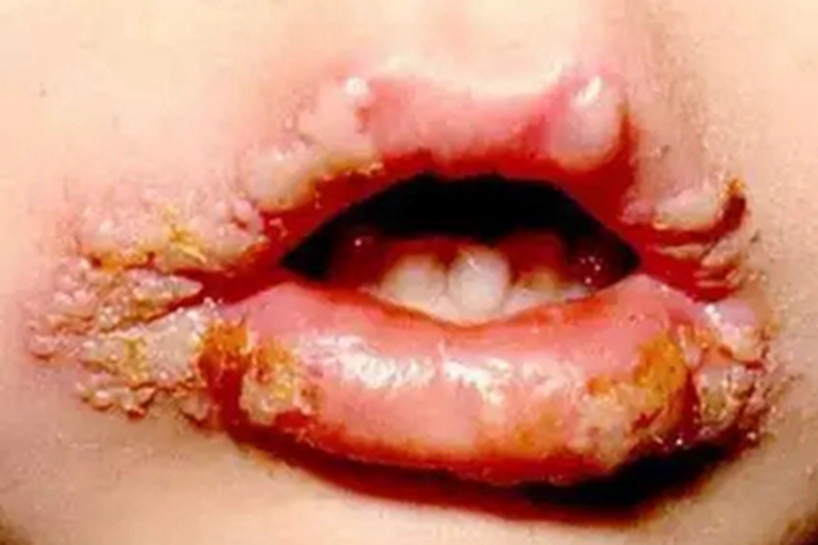 口腔单纯性疱疹症状图