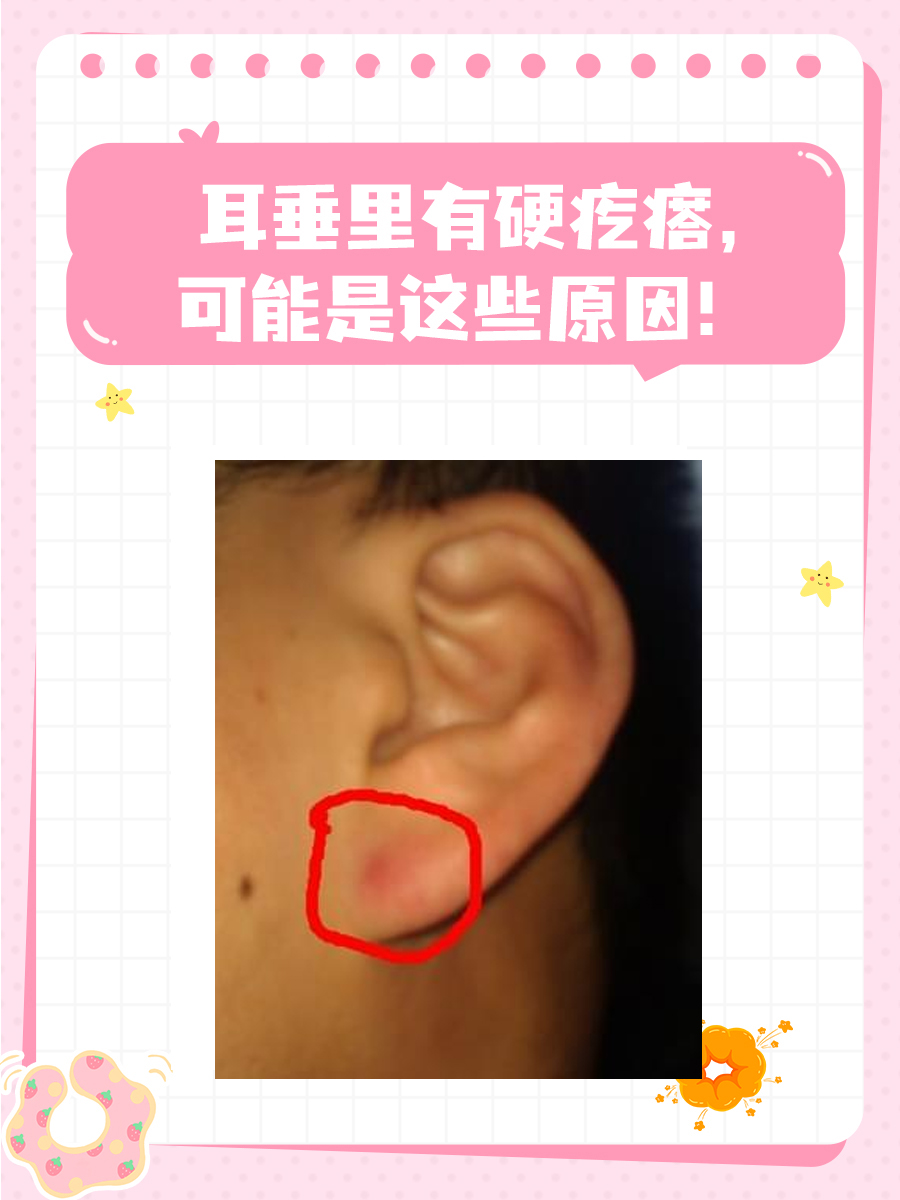耳垂里有硬疙瘩，可能是这些原因！